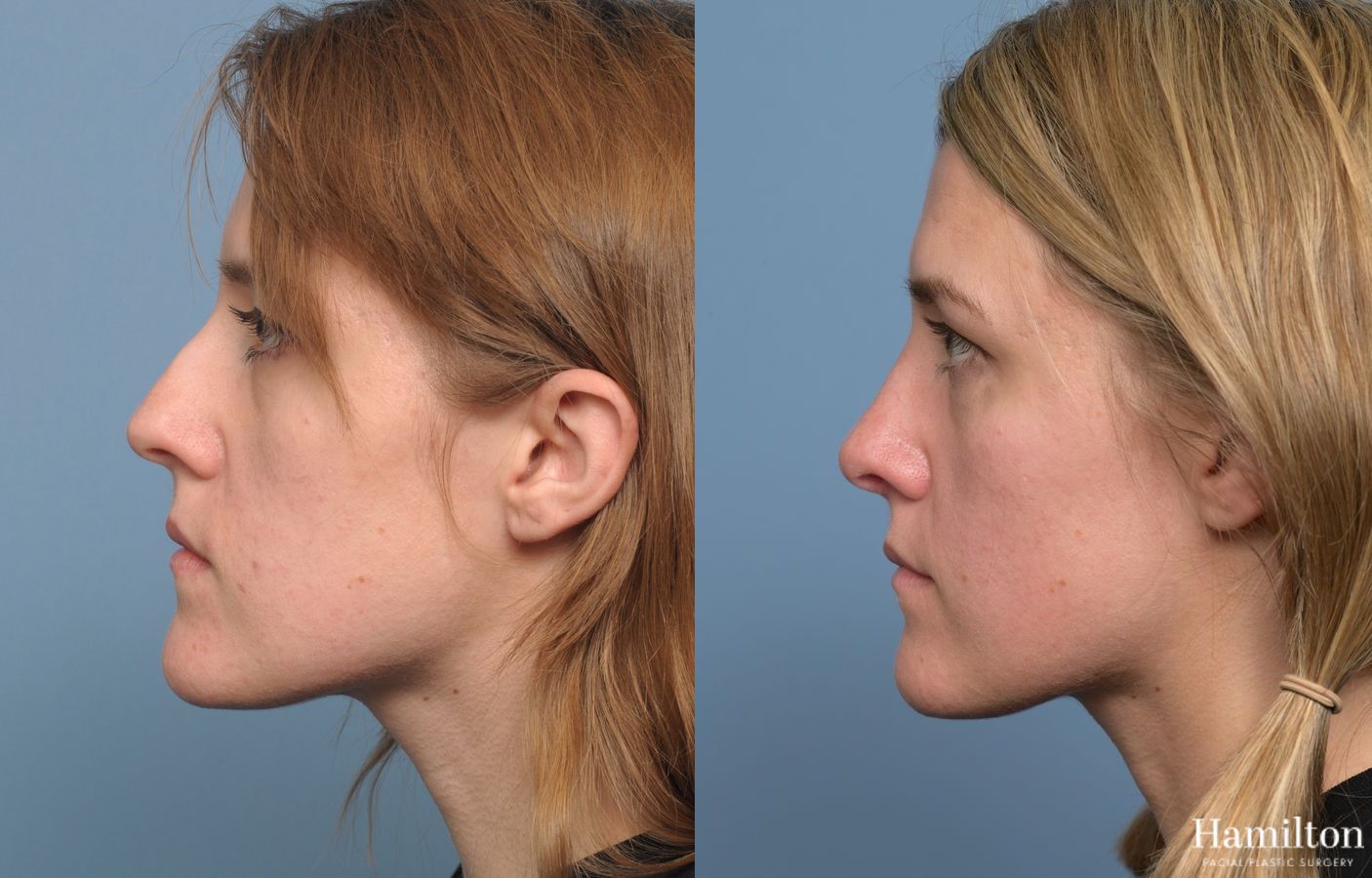 Before and after Rhinoplasty case 37136 - Angle 2