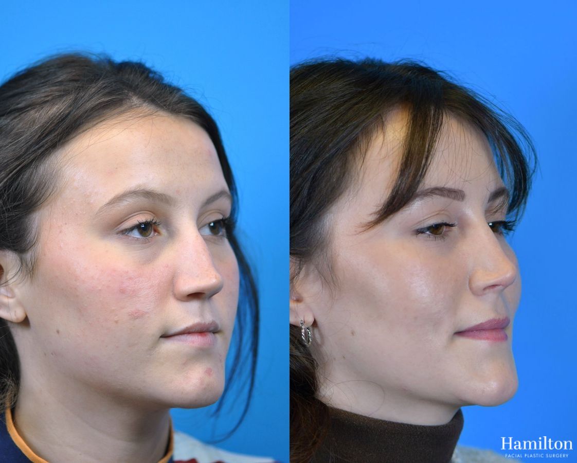 Before and after Rhinoplasty case 37275 - Angle 2