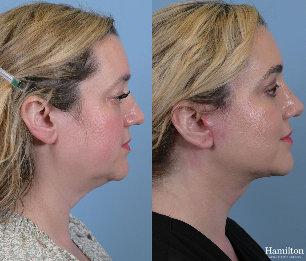 Before and after Rhinoplasty case 37276 - Angle 2