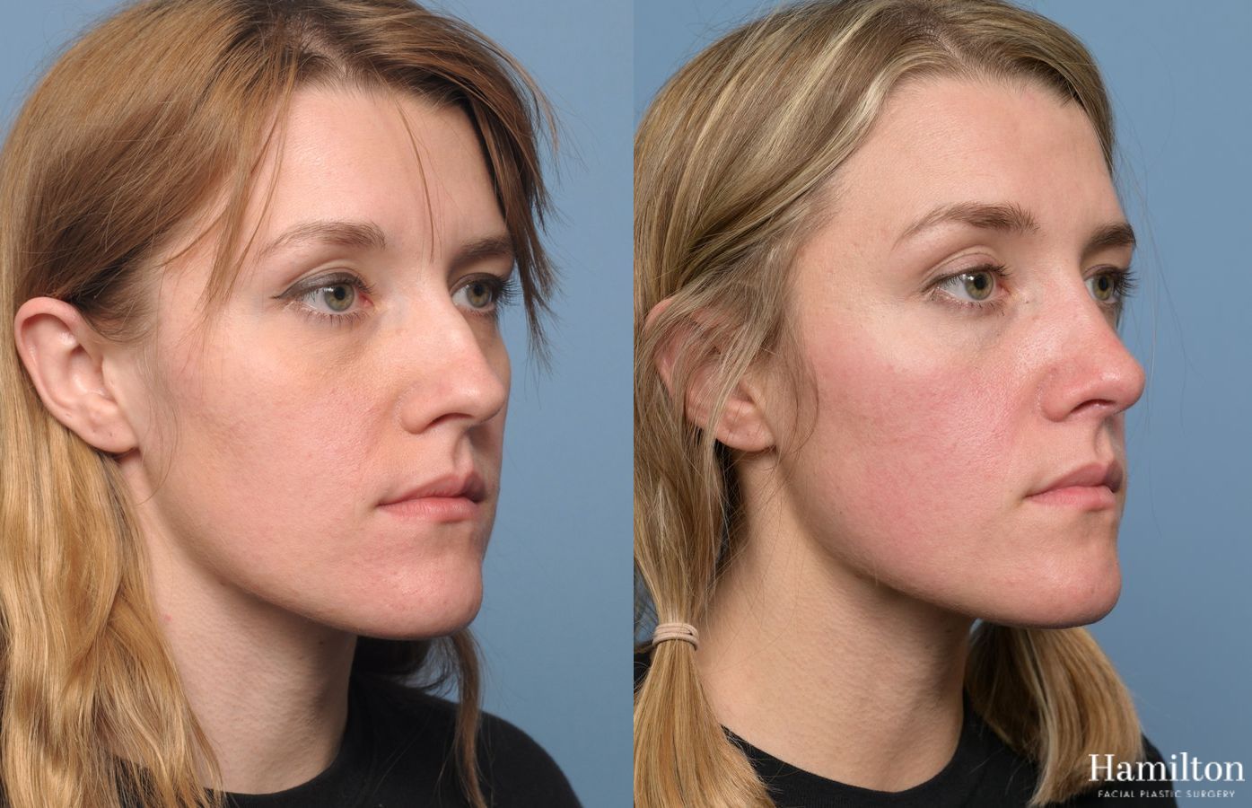 Before and after Rhinoplasty case 37136 - Angle 3