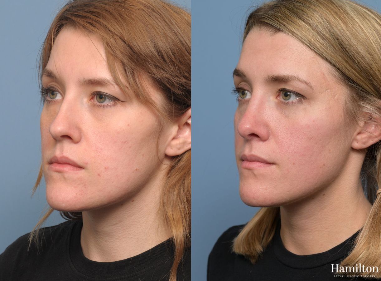 Before and after Rhinoplasty case 37136 - Angle 5