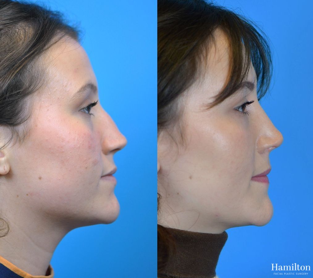 Before and after Rhinoplasty case 37275 - Angle 3