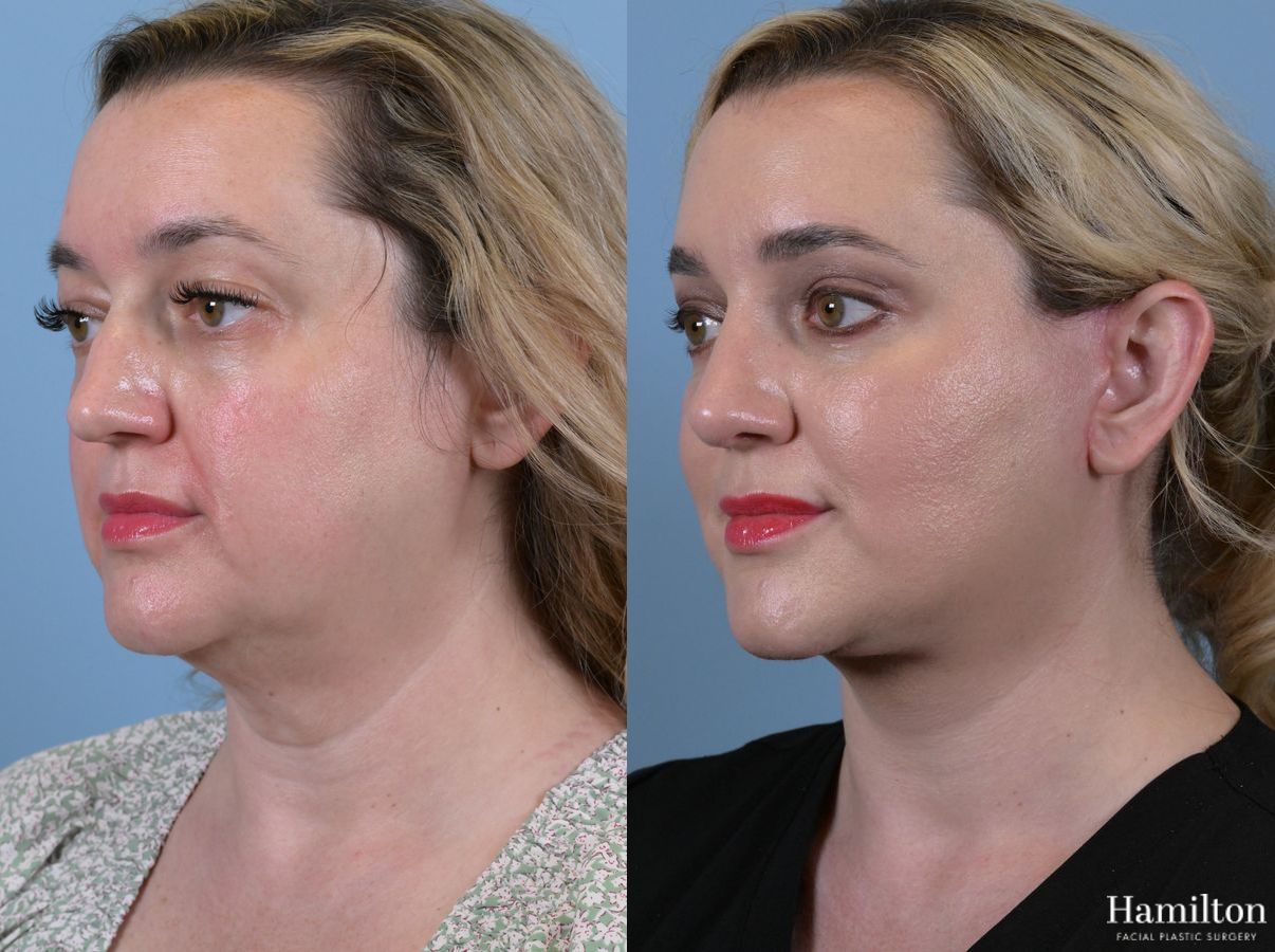 Before and after Rhinoplasty case 37276 - Angle 3