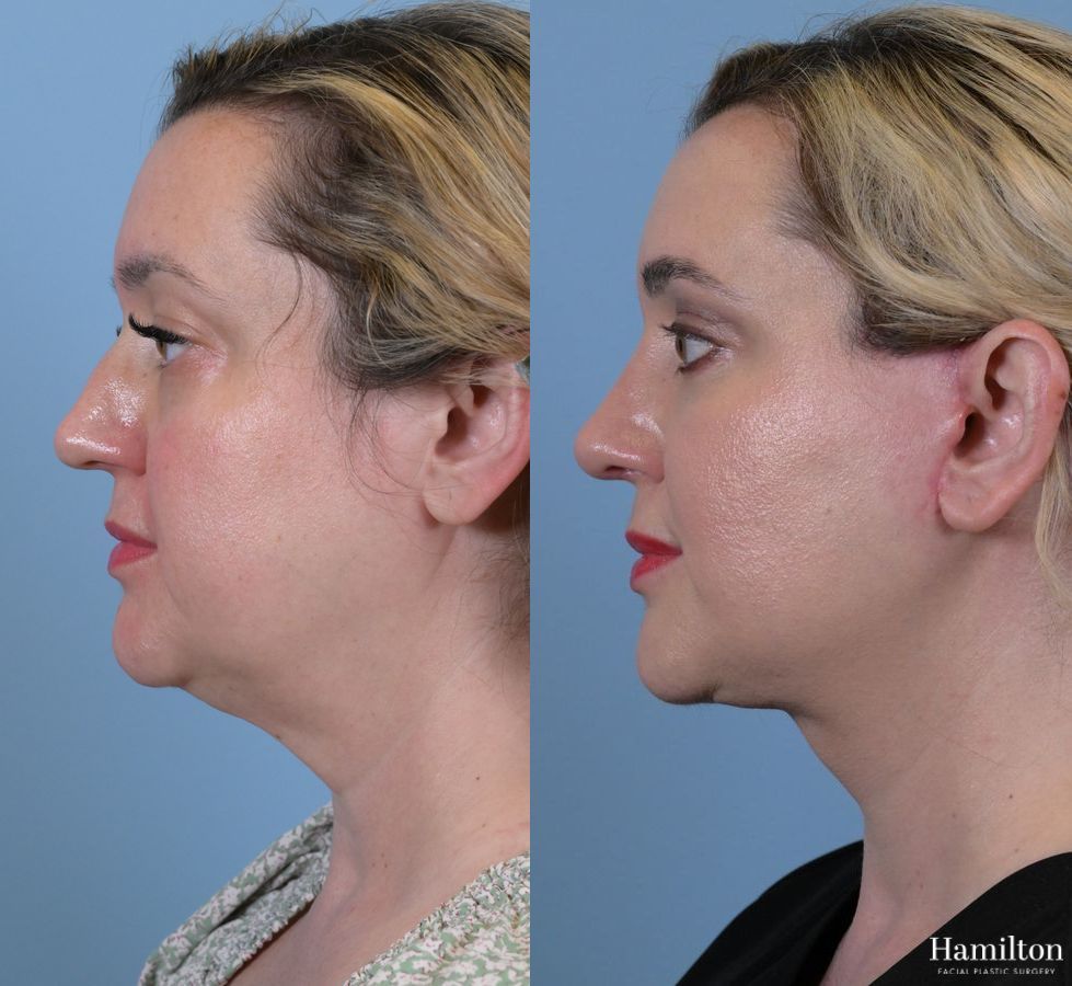 Before and after Rhinoplasty case 37276 - Angle 4
