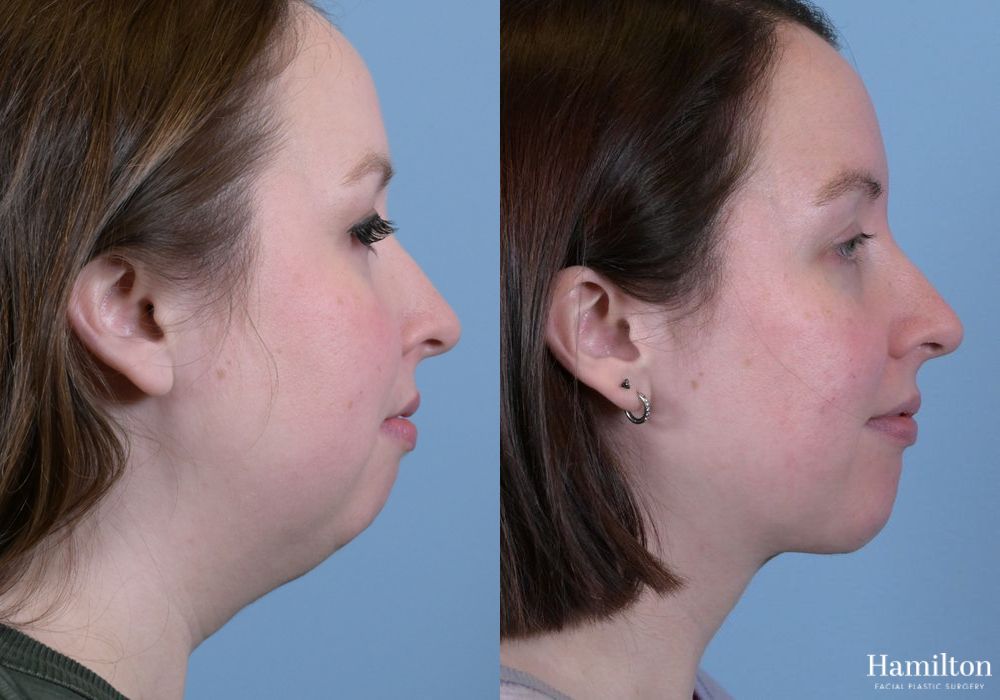 Before and after Submentoplasty/Deep Neck Lift case 37358 - Angle 2