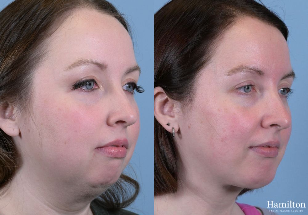 Before and after Submentoplasty/Deep Neck Lift case 37358 - Angle 5
