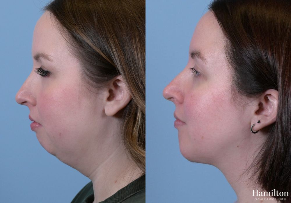 Before and after Submentoplasty/Deep Neck Lift case 37358