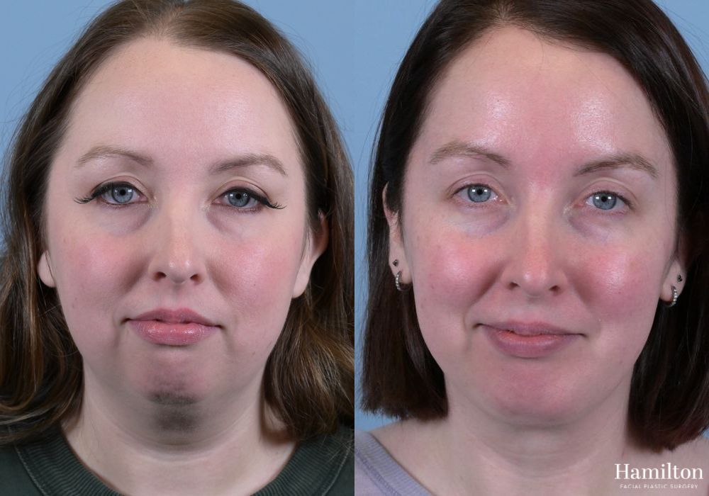 Before and after Submentoplasty/Deep Neck Lift case 37358 - Angle 3