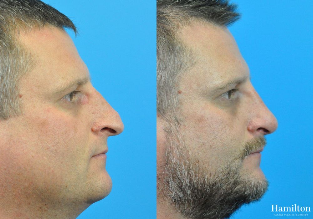 Before and after Rhinoplasty case 37312