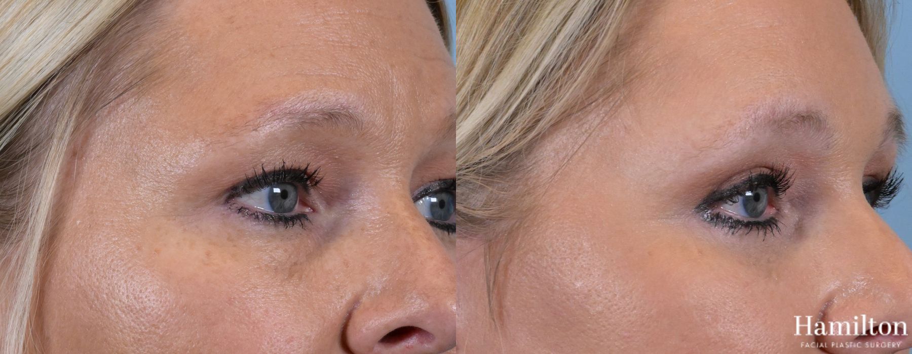 Before and after Blepharoplasty case 37227 - Angle 2