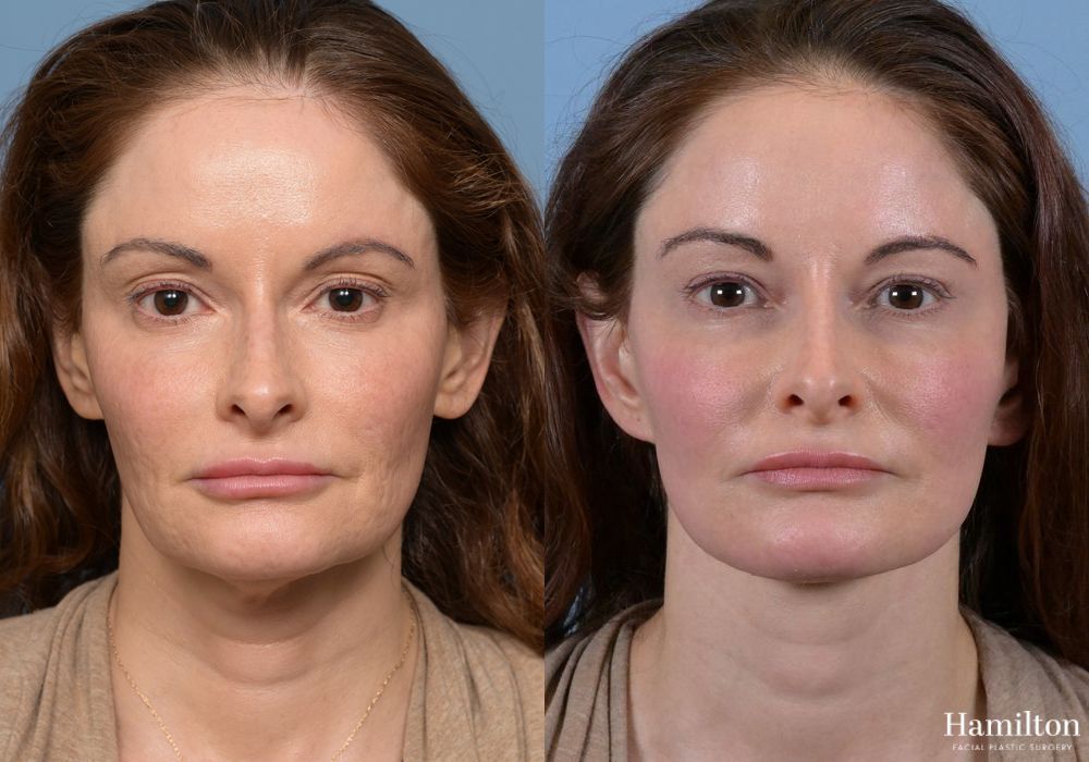 Before and after Neck Rejuvenation case 37096 - Angle 5