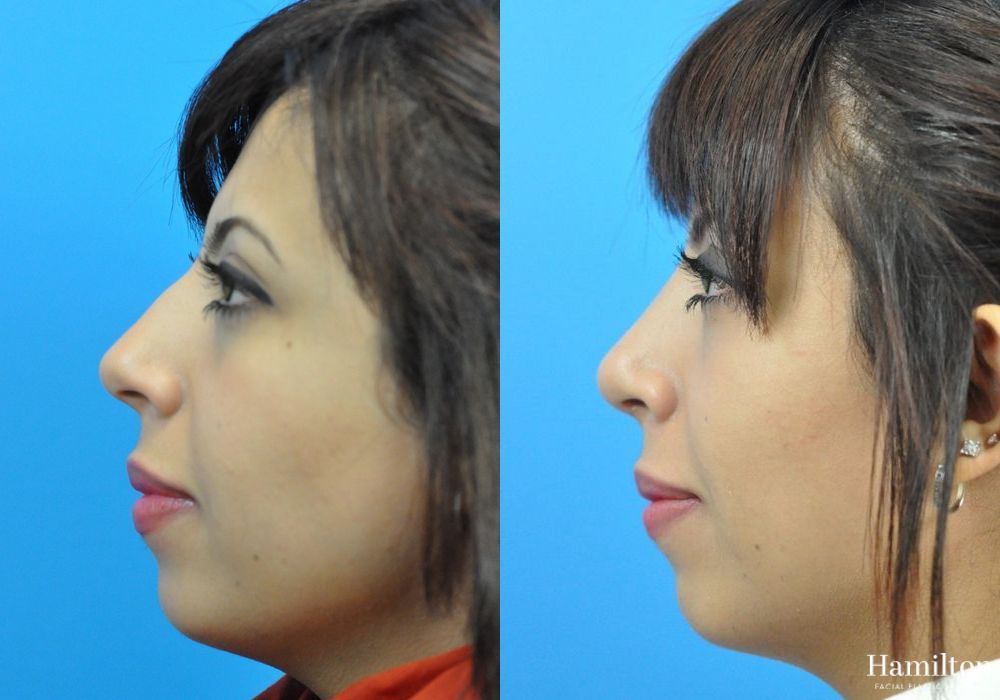 Before and after Rhinoplasty case 37268 - Angle 2