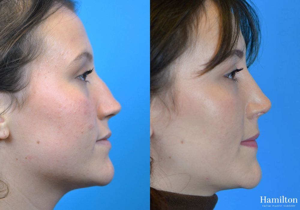 Before and after Rhinoplasty case 37275 - Angle 3