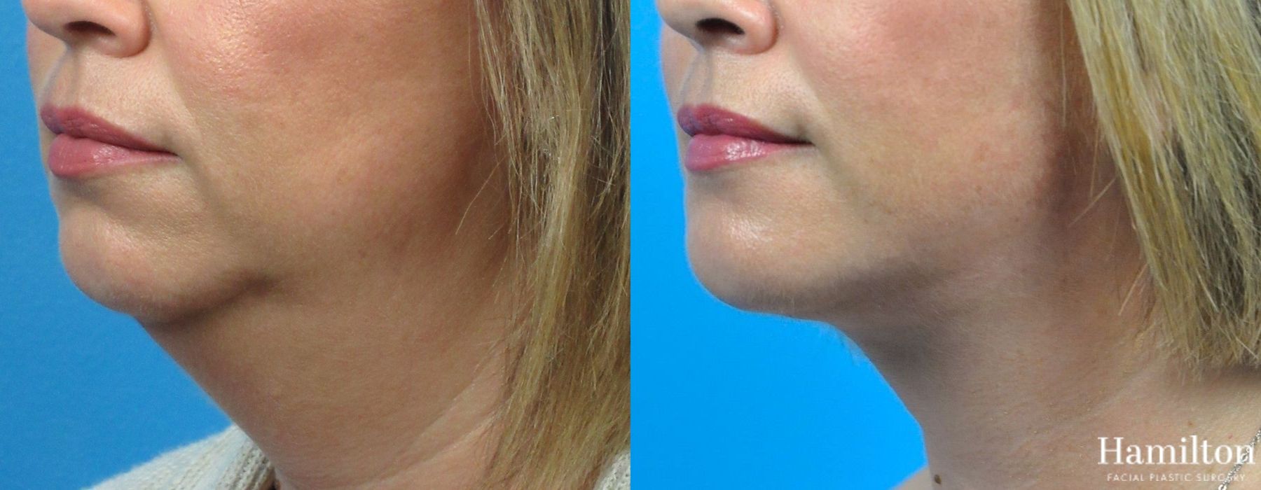 Before and after Neck Rejuvenation case 37246 - Angle 3