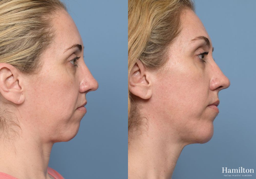 Before and after Chin Augmentation case 37179 - Angle 2