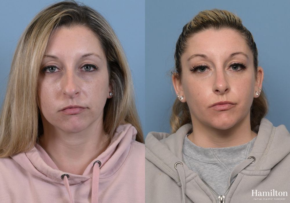 Before and after Rhinoplasty case 37239 - Angle 5