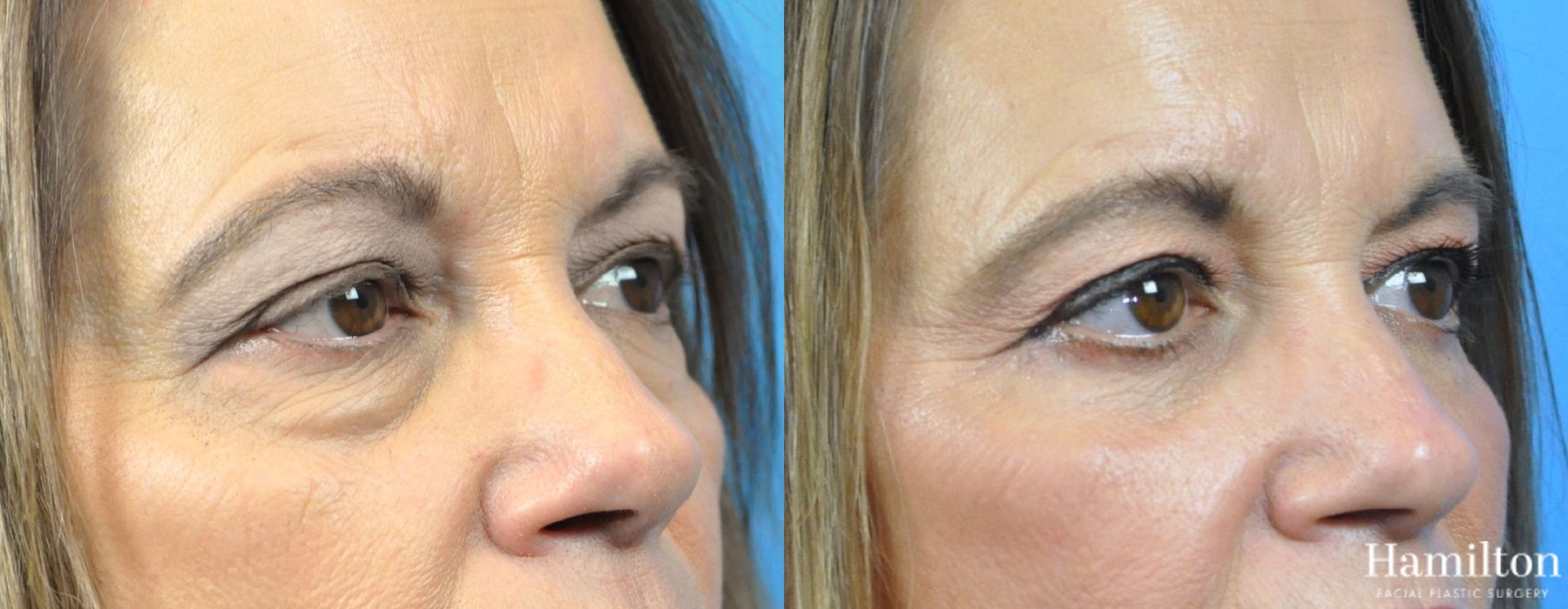 Before and after Blepharoplasty case 37226 - Angle 3