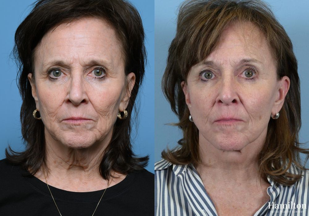 Before and after Facelift case 37338 - Angle 5