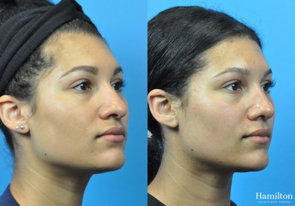 Before and after Rhinoplasty case 37331 - Angle 5