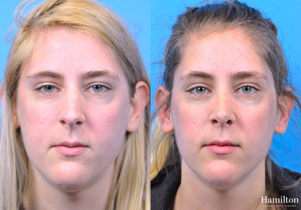 Before and after Rhinoplasty case 37354 - Angle 5