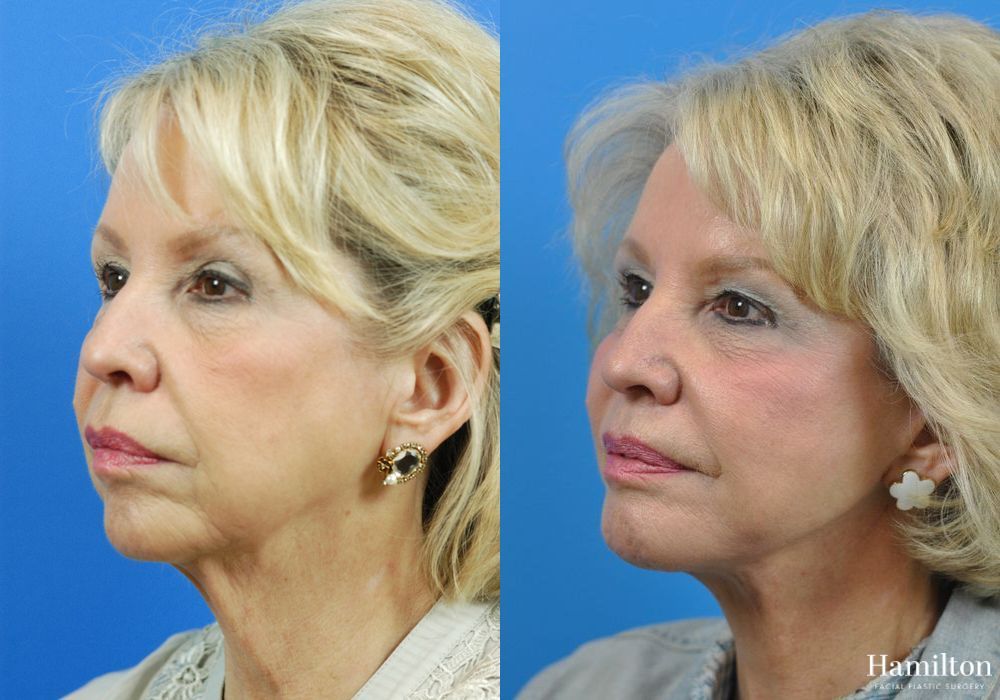 Before and after Facelift case 37314 - Angle 4