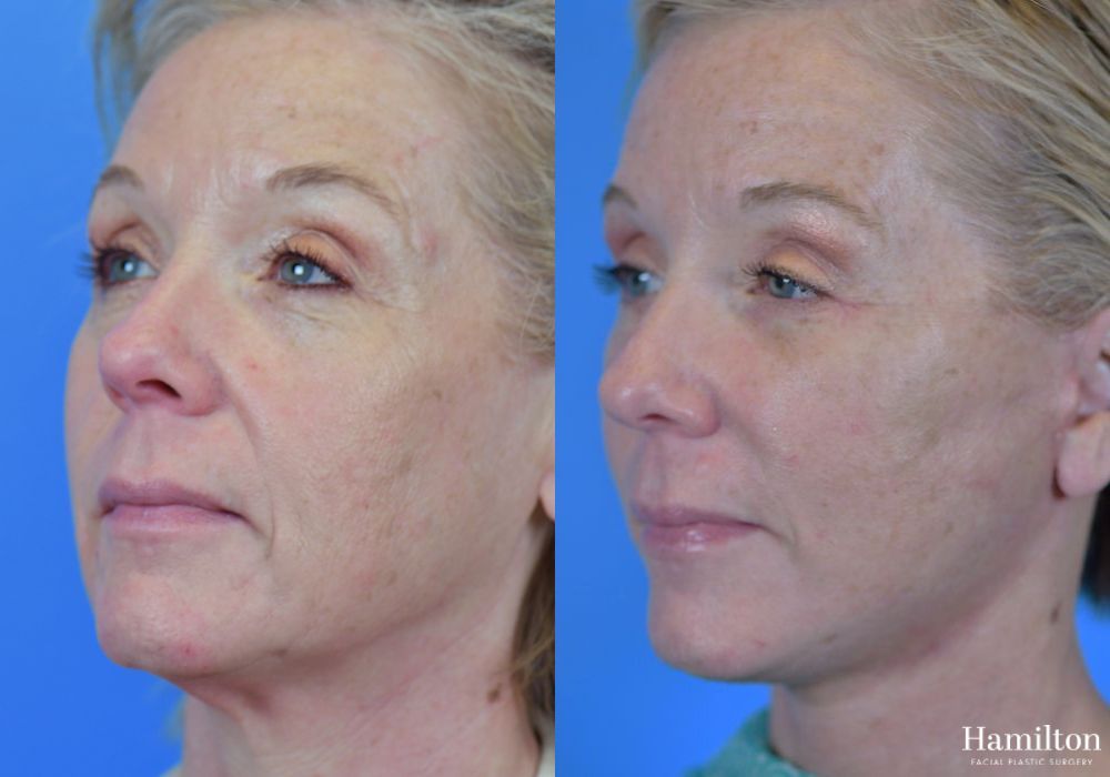 Before and after Facelift case 37316 - Angle 3