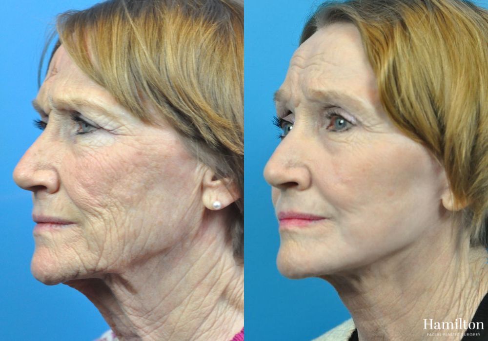 Before and after Laser - CO2 case 37231 - Angle 4