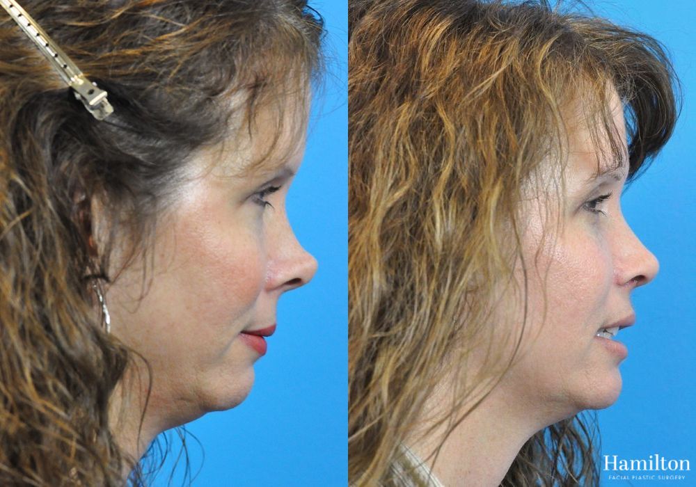 Before and after Rhinoplasty case 37292 - Angle 5