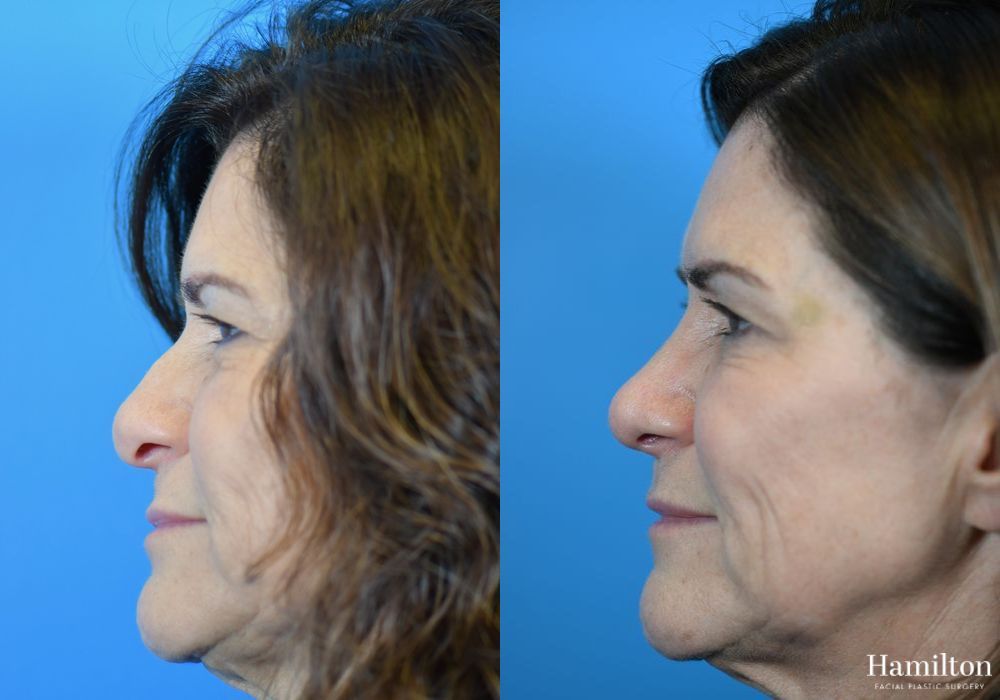Before and after Rhinoplasty case 37299 - Angle 2