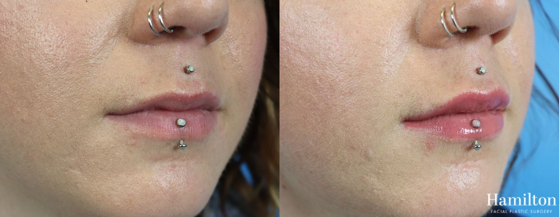 Before and after Lip Enhancement case 37190 - Angle 2