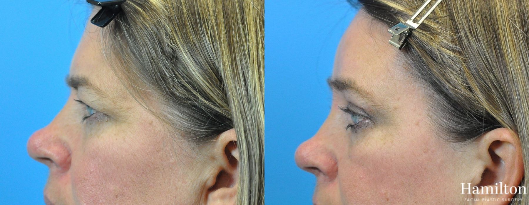 Before and after Blepharoplasty case 37272 - Angle 4