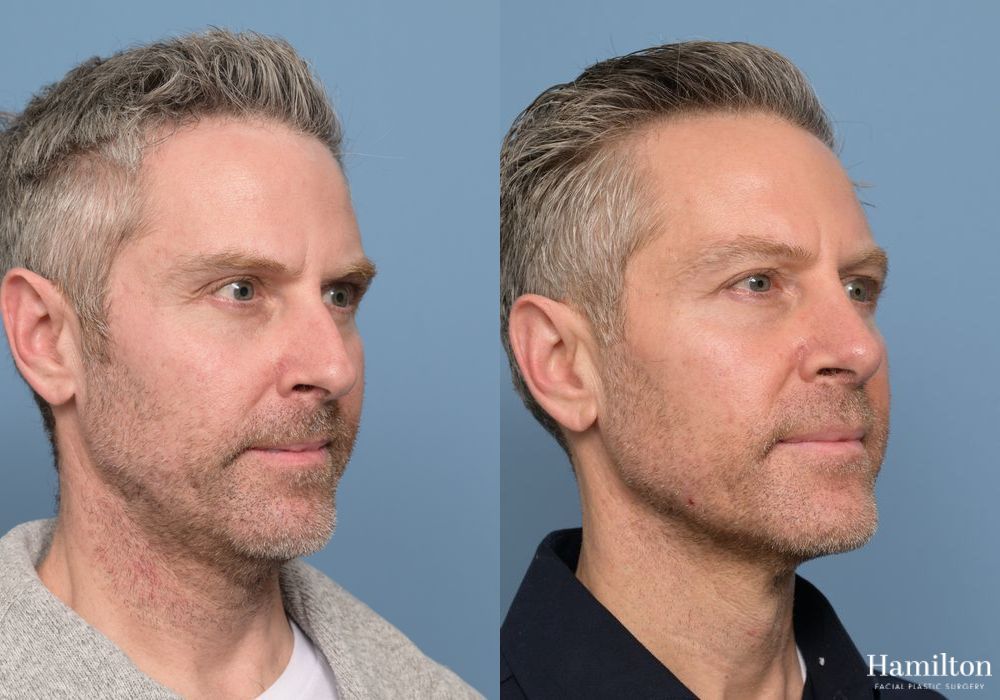 Before and after Rhinoplasty case 37134 - Angle 3