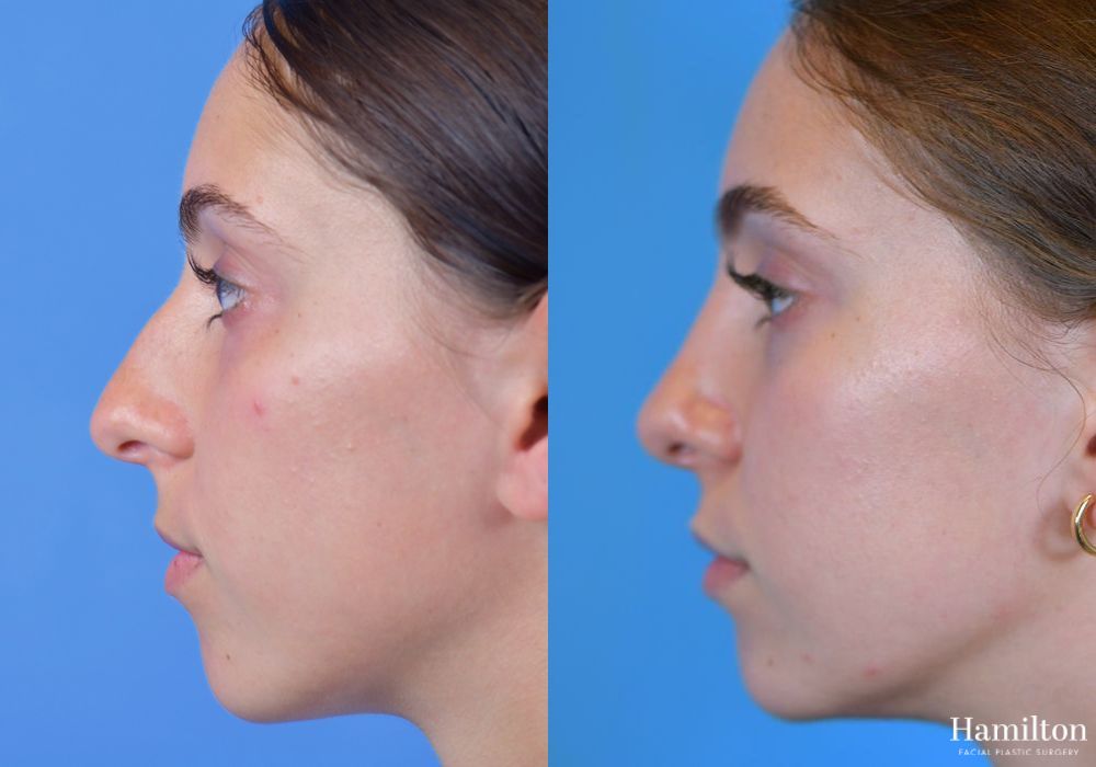 Before and after Rhinoplasty case 37198 - Angle 4