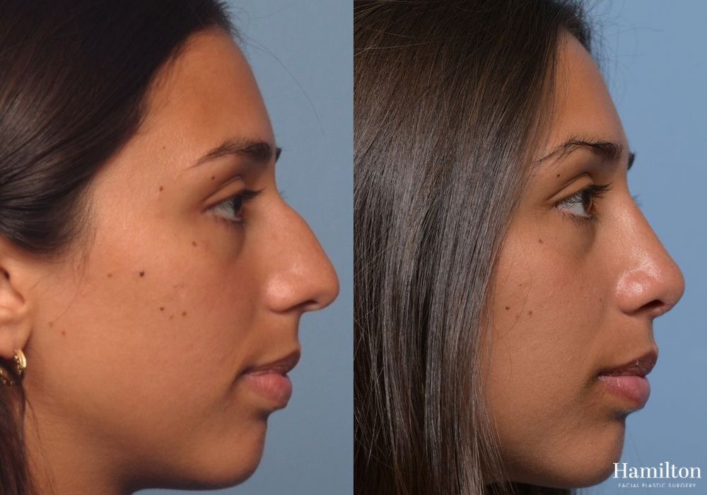 Before and after Rhinoplasty case 37177