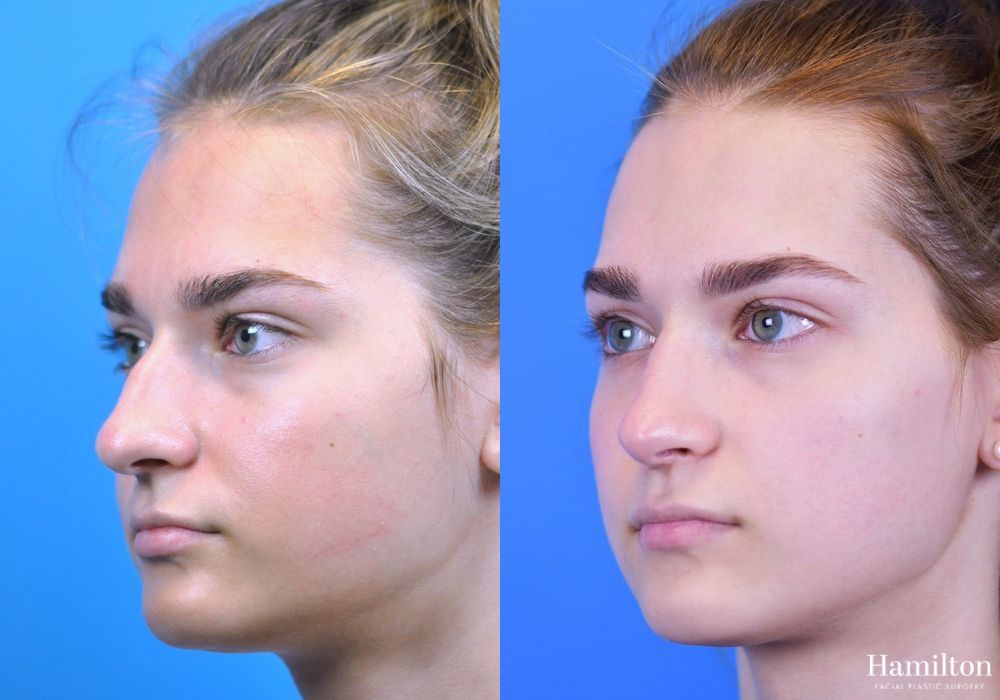 Before and after Rhinoplasty case 37251 - Angle 4