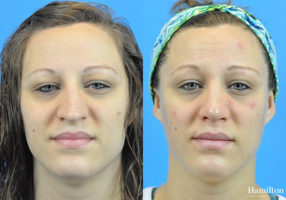 Before and after Rhinoplasty case 37357 - Angle 5