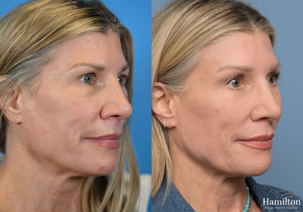 Before and after Brow Lift case 37196 - Angle 5