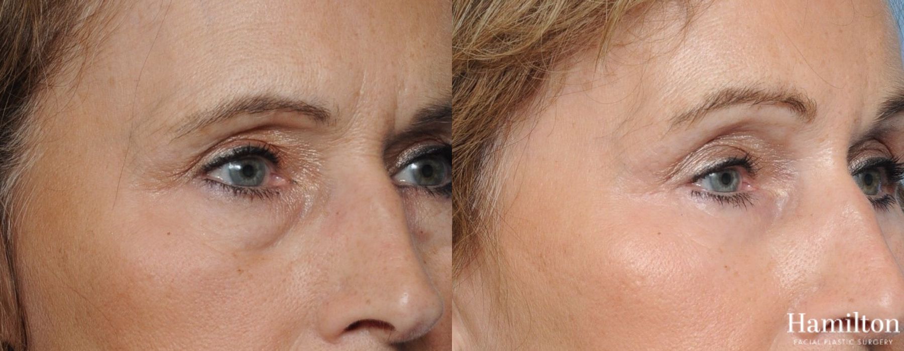 Before and after Blepharoplasty case 37305 - Angle 3