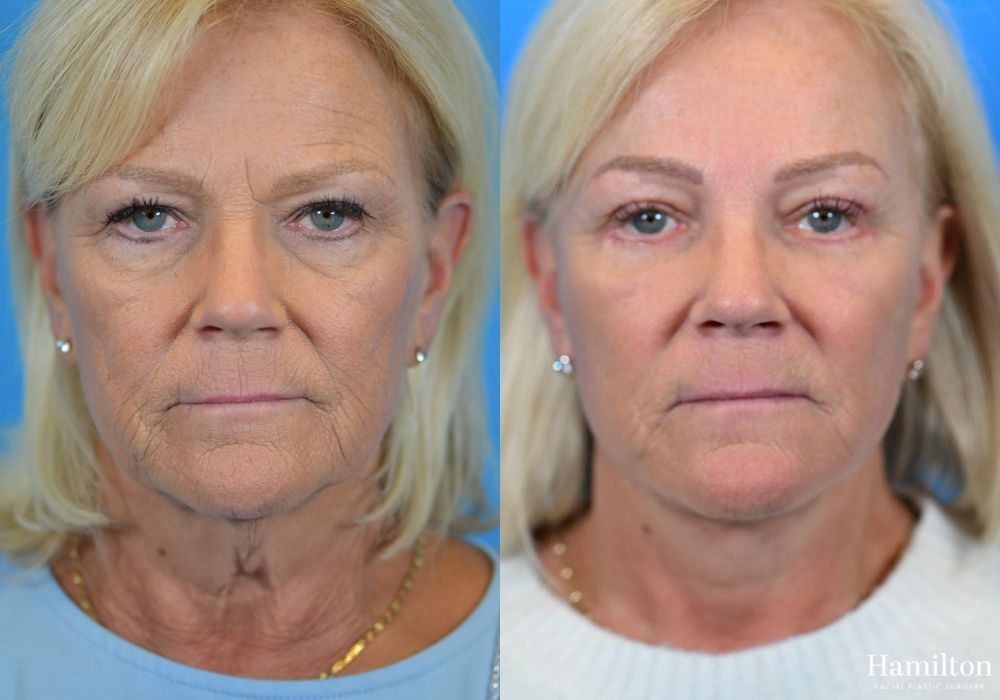Before and after Facelift case 37233 - Angle 2