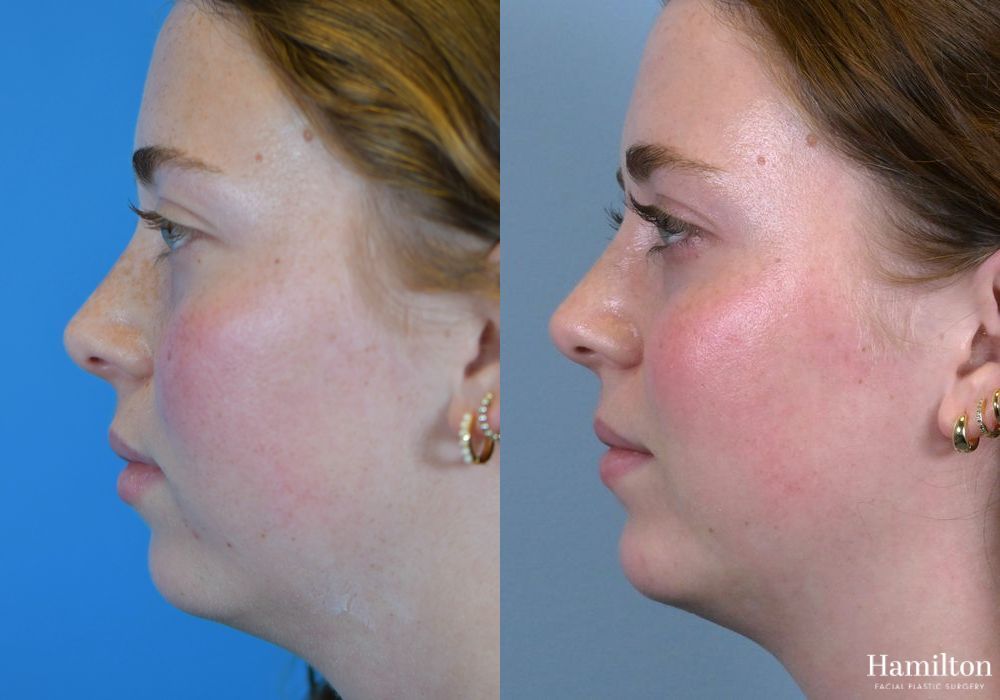 Before and after Chin Augmentation case 37176 - Angle 4