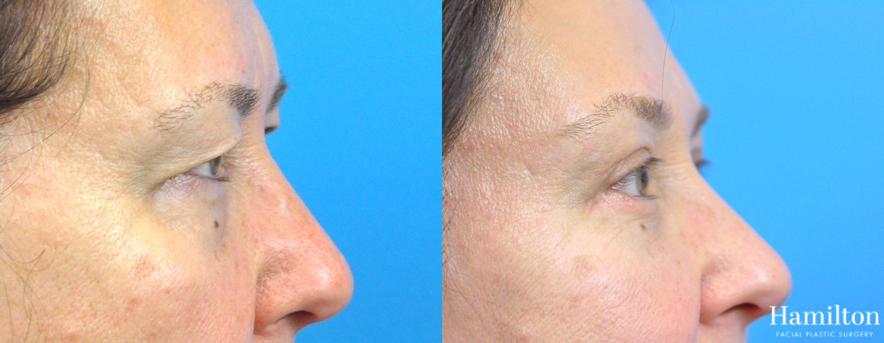 Before and after Blepharoplasty case 37308 - Angle 3