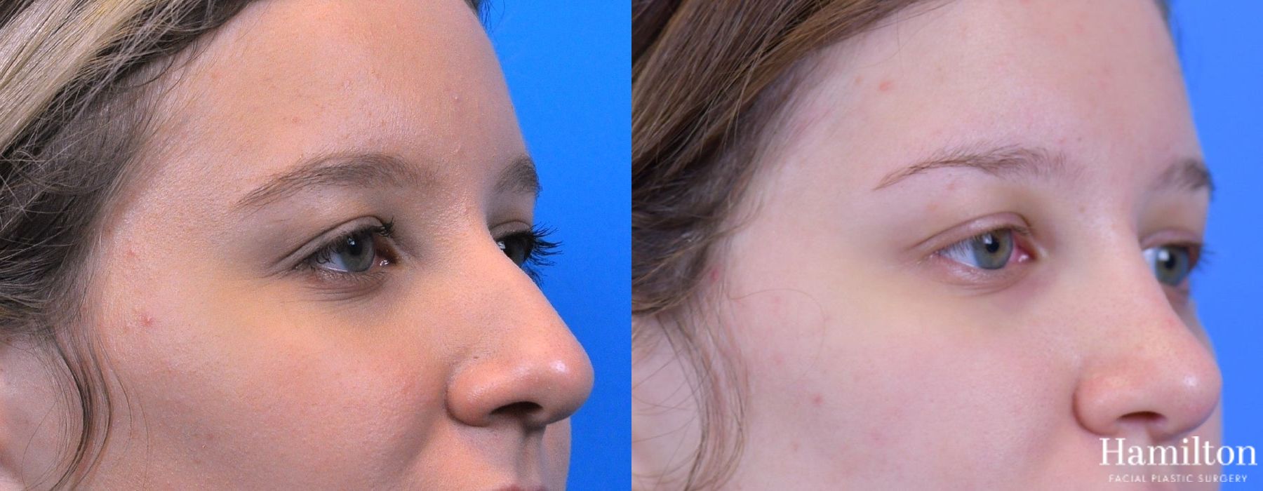 Before and after Rhinoplasty case 37269 - Angle 3