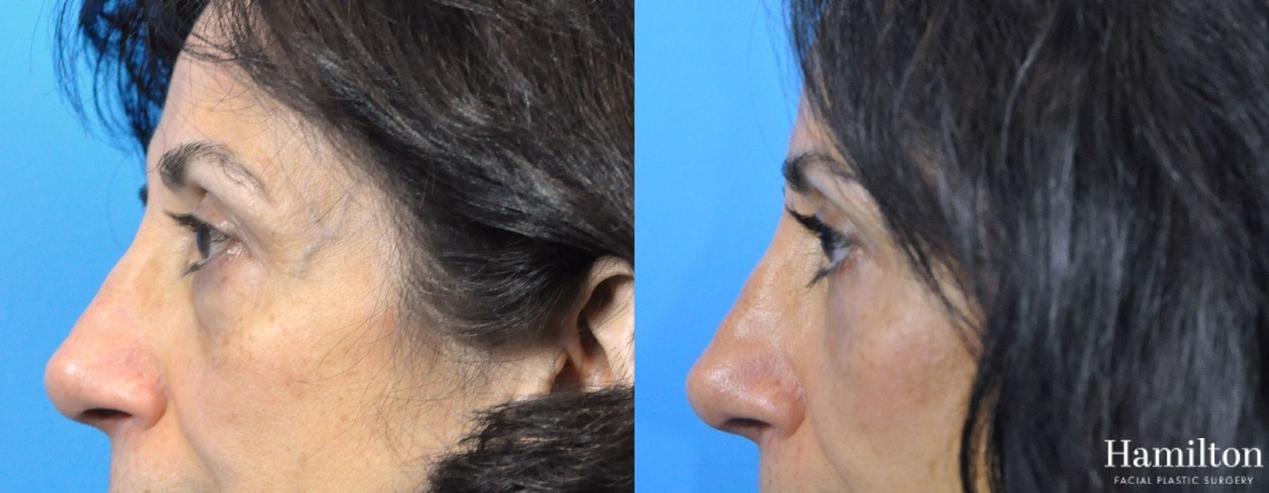 Before and after Blepharoplasty case 37262 - Angle 4
