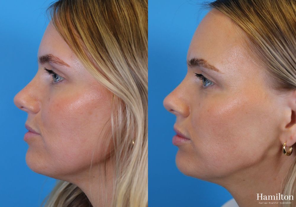 Before and after Lip Enhancement case 37237 - Angle 4