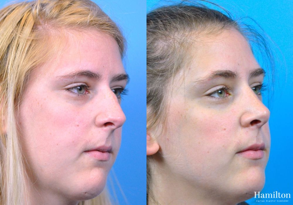 Before and after Rhinoplasty case 37354 - Angle 3