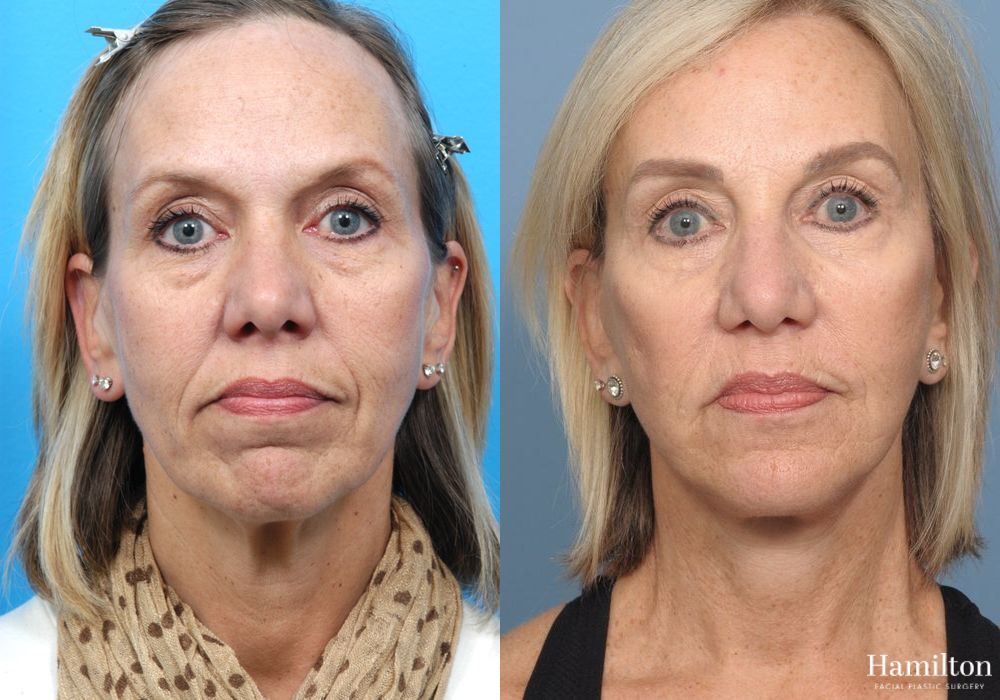 Before and after Chin Augmentation case 37147 - Angle 2