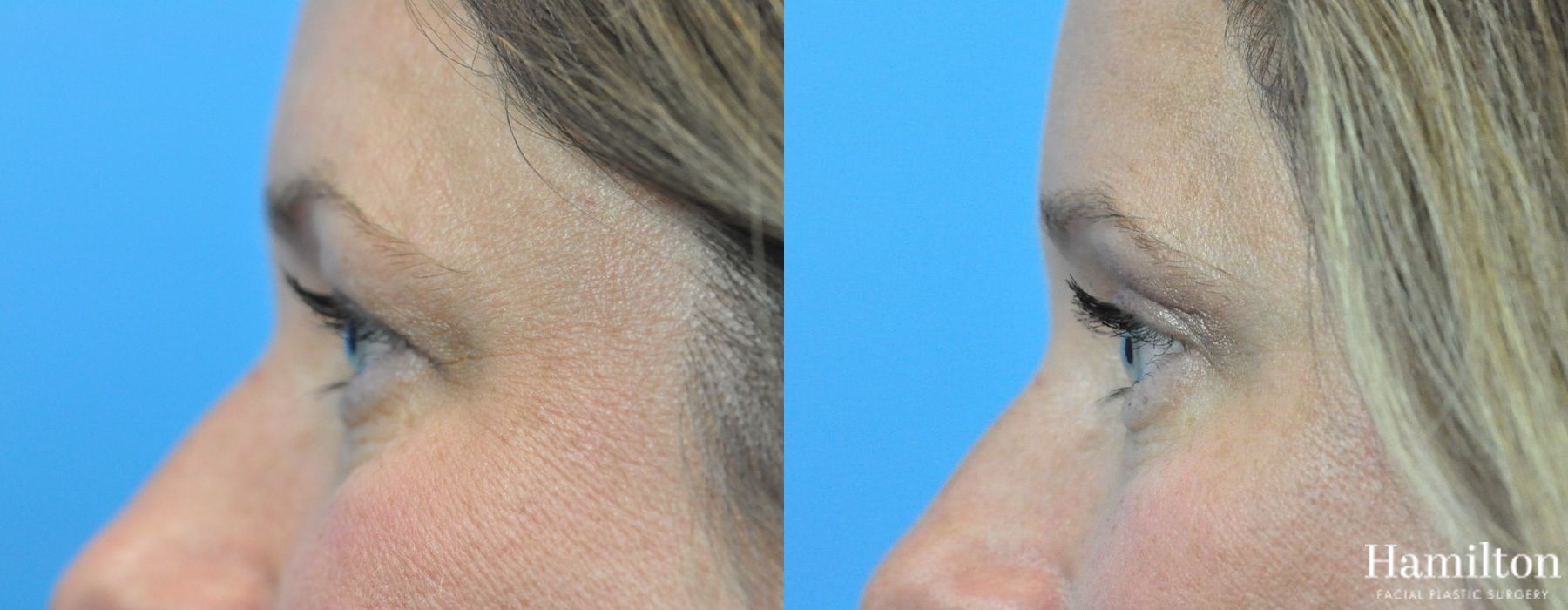 Before and after Blepharoplasty case 37307 - Angle 5