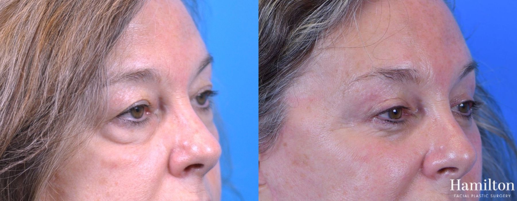 Before and after Blepharoplasty case 37310 - Angle 3