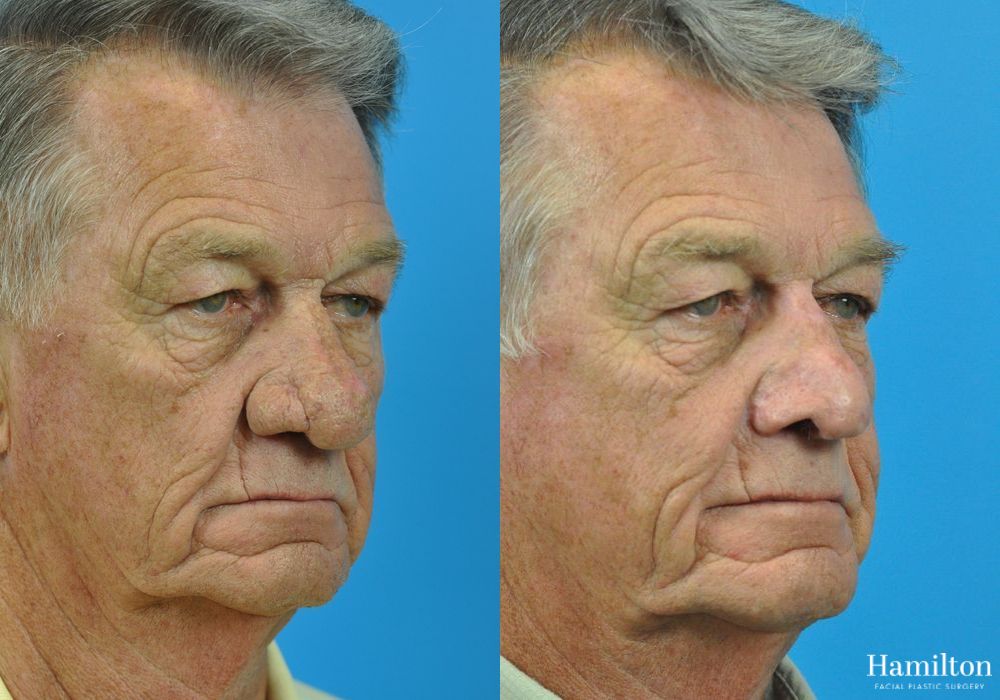 Before and after Rhinophyma case 37351