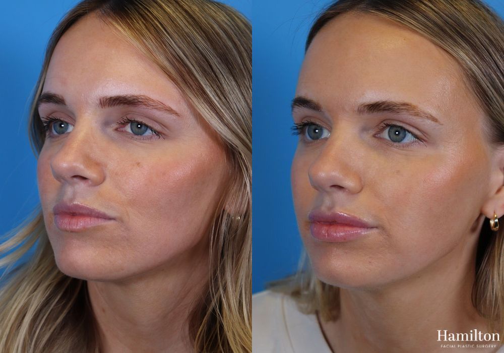 Before and after Lip Enhancement case 37237 - Angle 2
